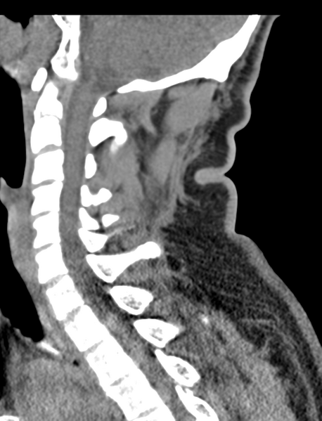 File:Axis peg fracture (type 3) and atlas lateral mass (type 4) fracture (Radiopaedia 37474-39324 D 37).png