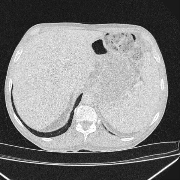 File:Azygos lobe (Radiopaedia 38259-40275 Axial lung window 78).jpg