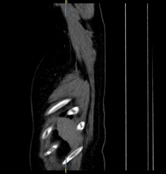 File:Azygos vein aneurysm (Radiopaedia 77824-90130 D 2).JPG
