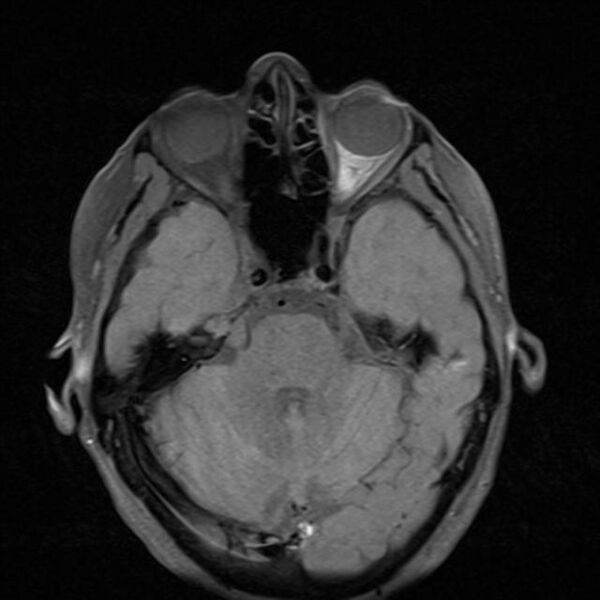 File:Base of skull chondrosarcoma (Radiopaedia 30410-31070 Axial T1 fat sat 11).jpg