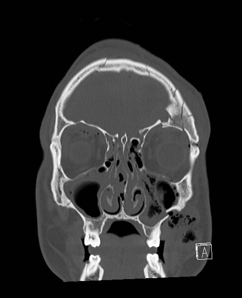 File:Base of skull fracture with bilateral Le Fort fractures (Radiopaedia 47094-51638 Coronal bone window 78).jpg