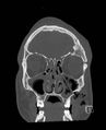 Base of skull fracture with bilateral Le Fort fractures (Radiopaedia 47094-51638 Coronal bone window 78).jpg