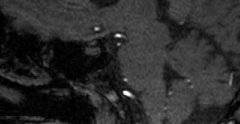 File:Basilar artery fenestration (Radiopaedia 74537-85455 Sagittal MRA TOF 30).jpg