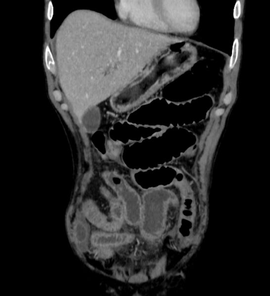 File:Behçet's disease- abdominal vasculitis (Radiopaedia 55955-62570 B 7).jpg