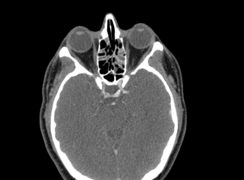 File:Benign mixed salivary tumor of the parotid gland (Radiopaedia 35261-36792 A 2).jpg