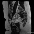 Bicornuate uterus- on MRI (Radiopaedia 49206-54297 Sagittal T2 4).jpg