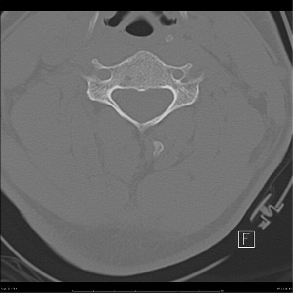 File:Bilateral cervical ribs (Radiopaedia 25868-26017 Axial bone window 25).jpg