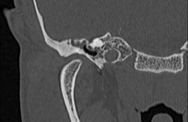 File:Bilateral cholesteatoma (Radiopaedia 54898-61172 Coronal bone window 18).jpg