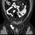 Bilateral direct inguinal herniae (Radiopaedia 17016-16719 A 7).jpg