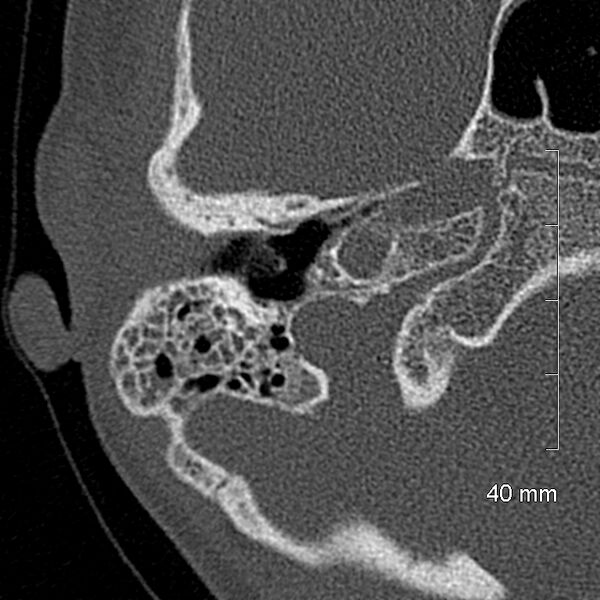 File:Bilateral grommets (Radiopaedia 47710-52404 Axial bone window 28).jpg