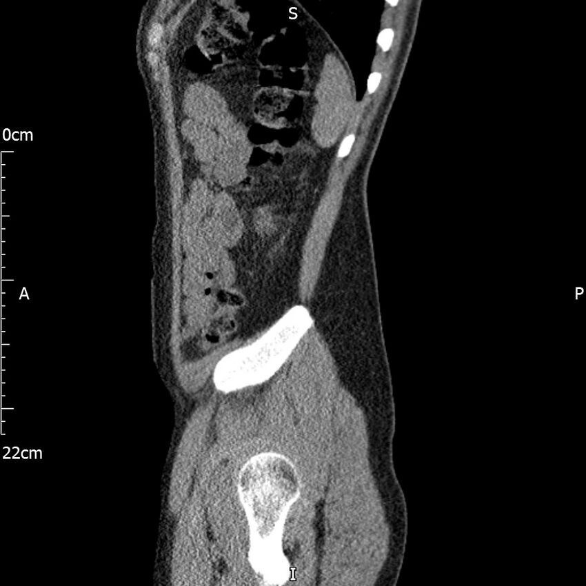 Bilateral medullary nephrocalcinosis with ureteric calculi (Radiopaedia 71269-81569 C 24).jpg