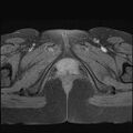 Bilateral ovarian endometriomas (Radiopaedia 87085-103347 Axial T1 fat sat 23).jpg