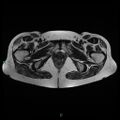 Bilateral ovarian fibroma (Radiopaedia 44568-48293 Axial T2 27).jpg