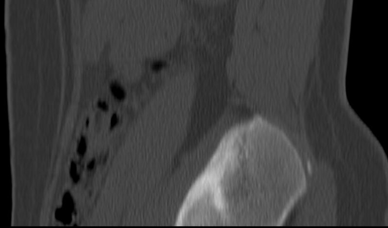 File:Bilateral pars defect (Radiopaedia 26691-26846 Sagittal bone window 3).jpg