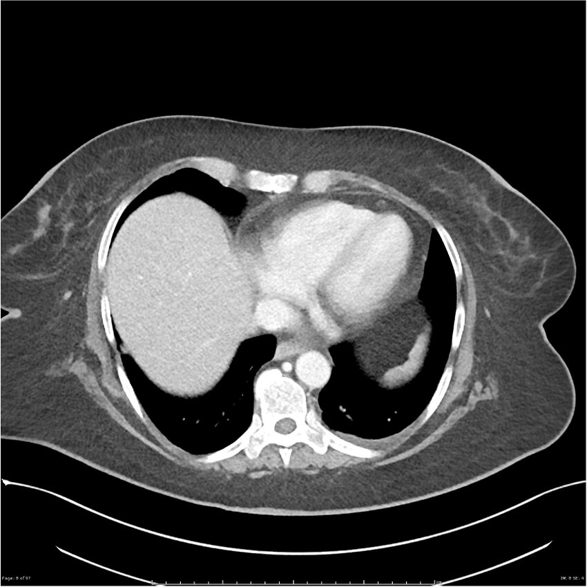 Bilateral psoas hematomas (Radiopaedia 24057-24279 A 8).jpg