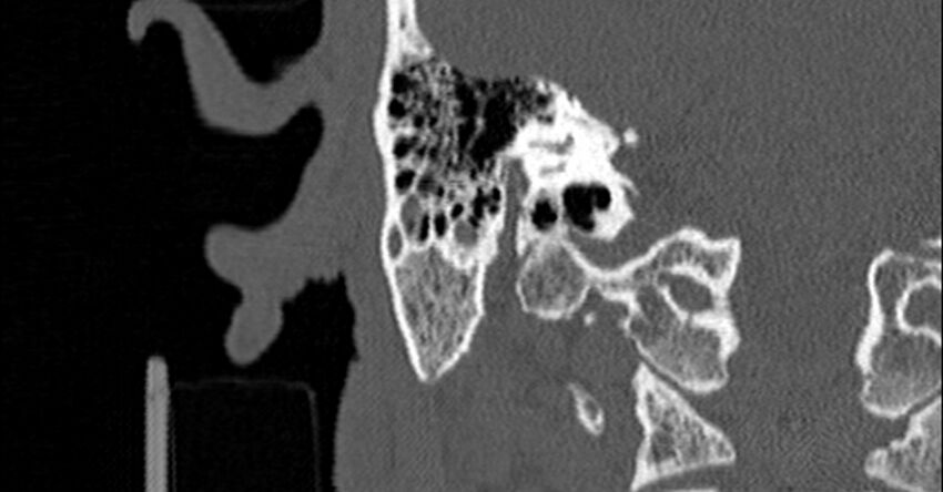 Bilateral temporal bone fractures (Radiopaedia 29482-29970 Coronal non-contrast 131).jpg