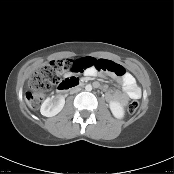 File:Bilateral ureteritis and cystitis (Radiopaedia 25340-25594 A 33).jpg