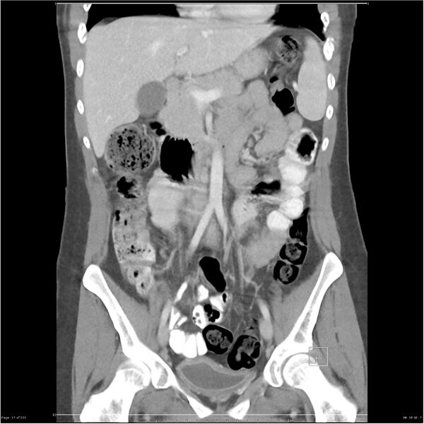 File:Bilateral ureteritis and cystitis (Radiopaedia 25340-25594 B 17).jpg