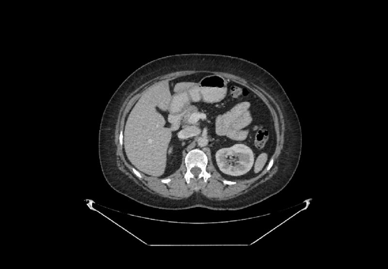 File:Bilateral urolithiasis with incidentally detected splenic artery aneurysm and left inferior vena cava (Radiopaedia 44467-48127 B 25).jpg