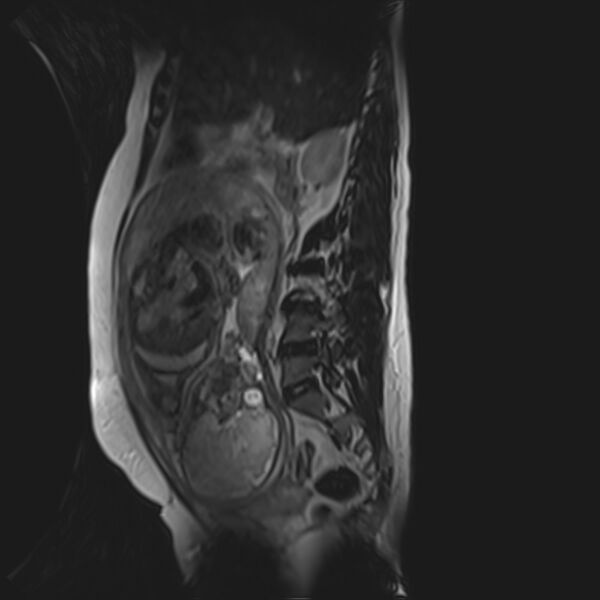 File:Bilobed placenta accreta (Radiopaedia 69648-79591 G 34).jpg