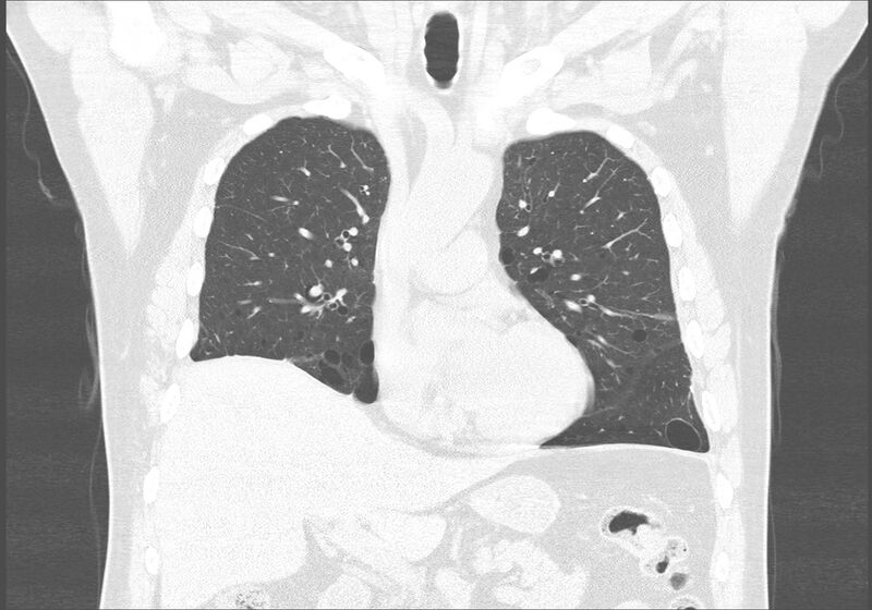 File:Birt-Hogg-Dubé syndrome (Radiopaedia 52578-58491 Coronal lung window 21).jpg