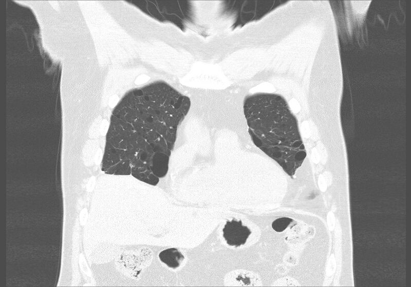 File:Birt-Hogg-Dubé syndrome (Radiopaedia 52578-58491 Coronal lung window 8).jpg