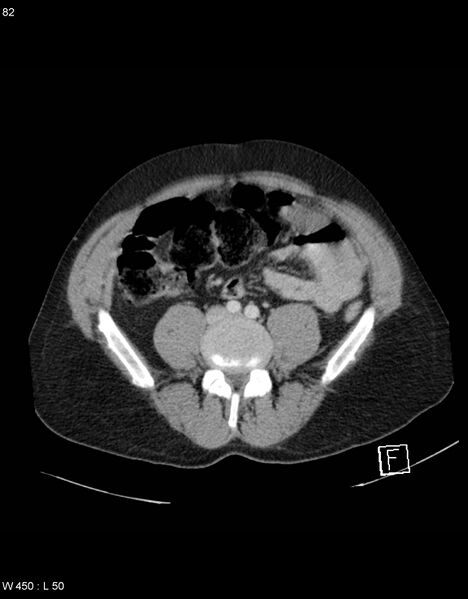 File:Boerhaave syndrome with tension pneumothorax (Radiopaedia 56794-63603 A 41).jpg