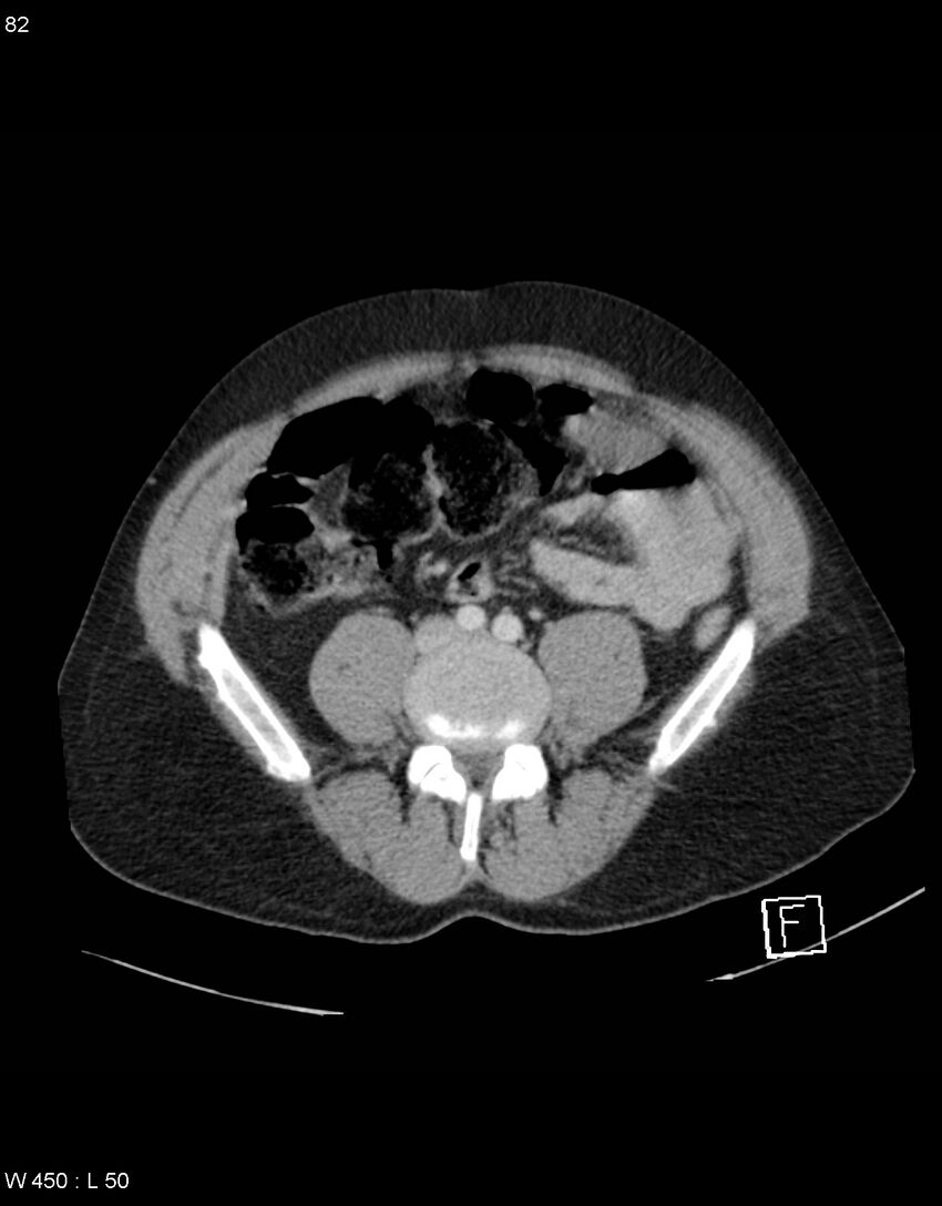 Boerhaave syndrome with tension pneumothorax (Radiopaedia 56794-63603 A 41).jpg