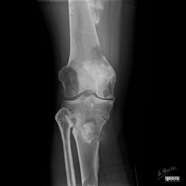 File:Bone lesion differential diagnosis - illustrations (Radiopaedia 79247-94246 B 1).jpg