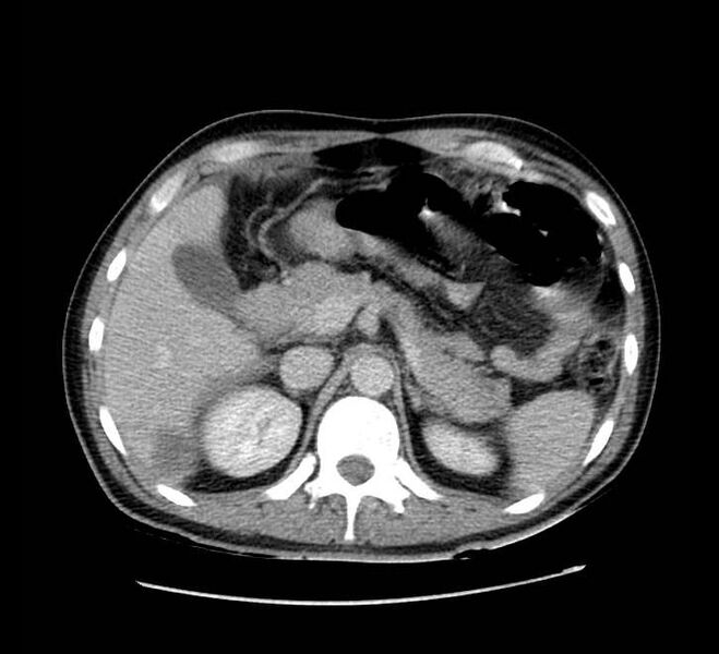 File:Bowel obstruction from colon carcinoma (Radiopaedia 22995-23028 A 23).jpg