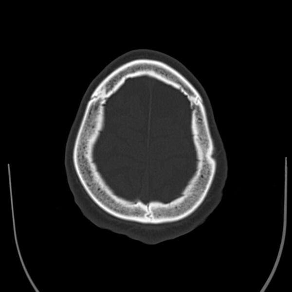 File:Brain Pantopaque remnants (Radiopaedia 78403-91048 Axial bone window 59).jpg