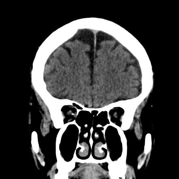 File:Brain Pantopaque remnants (Radiopaedia 78403-91048 Coronal non-contrast 19).jpg