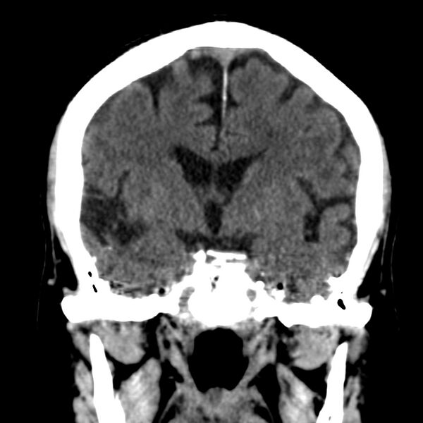 File:Brain Pantopaque remnants (Radiopaedia 78403-91048 Coronal non-contrast 33).jpg