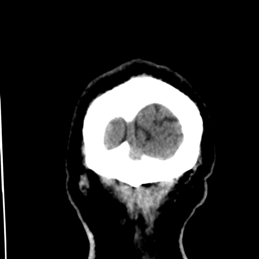 Brain Pantopaque remnants (Radiopaedia 78403-91048 Coronal non-contrast 69).jpg