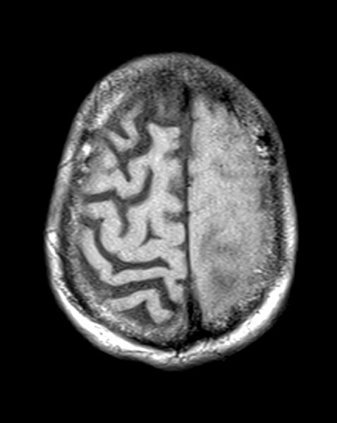 File:Brain abscess with dual rim sign (Radiopaedia 87566-103938 Axial T1 21).jpg