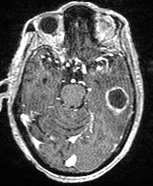 File:Brain abscess with dual rim sign (Radiopaedia 87566-103938 Axial T1 C+ 62).jpg