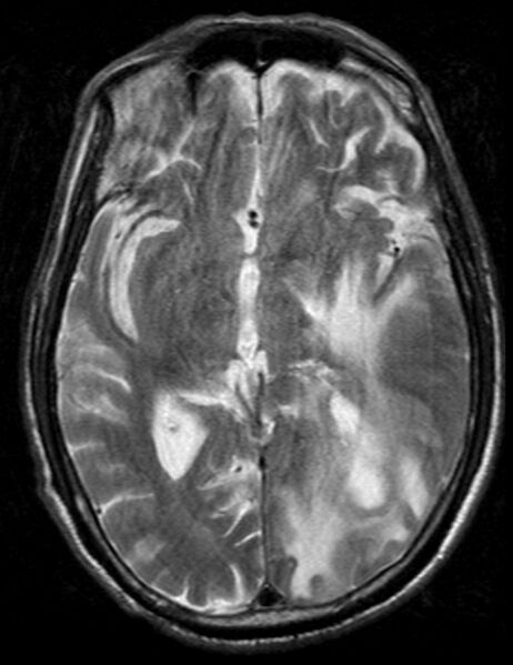File:Brain abscess with dual rim sign (Radiopaedia 87566-103938 Axial T2 11).jpg