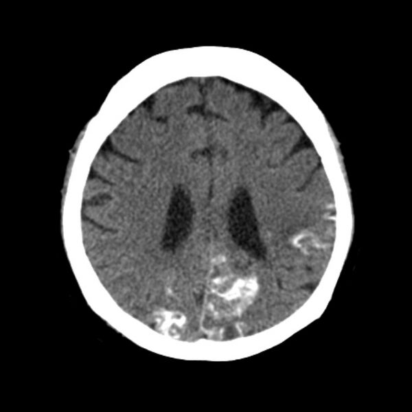 File:Brain cortical laminar necrosis (Radiopaedia 25822-25971 Axial non-contrast 30).jpg