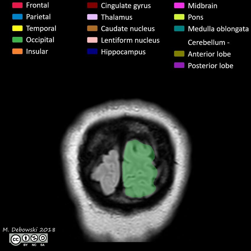 Brain lobes - annotated MRI (Radiopaedia 61691-69700 Coronal 73).JPG