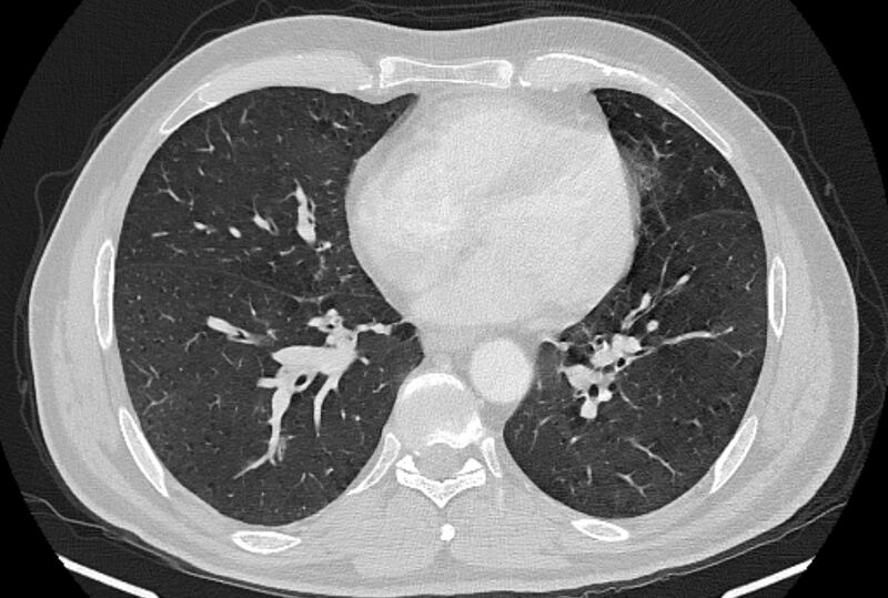 File:Brain metastases - lung cancer primary (Radiopaedia 75060-86116 Axial lung window 38).jpg