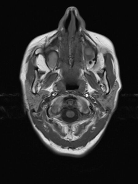 File:Brain metastasis as initial presentation of non-small cell lung cancer (Radiopaedia 65122-74126 Axial T1 2).jpg