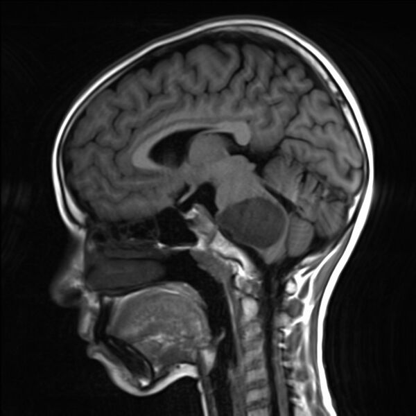 File:Brainstem glioma (Radiopaedia 70548-80674 Sagittal T1 13).jpg