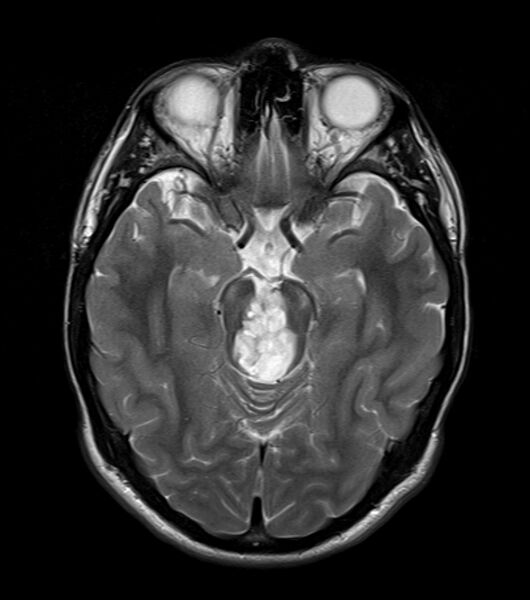 File:Brainstem glioma - focal midbrain (Radiopaedia 6525-67551 Axial T2 1).jpg