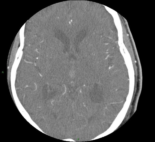 File:Brainstem hemorrhage (Radiopaedia 58794-66028 D 97).jpg