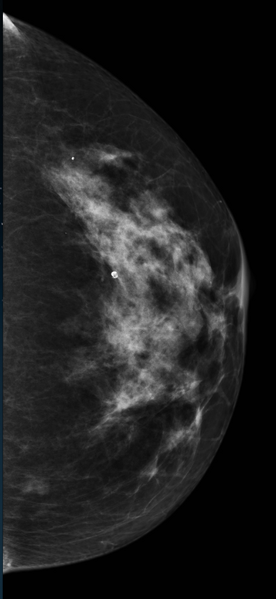 File:Breast asymmetry - interpretation pitfall (Radiopaedia 21654-21613 CC 1).png