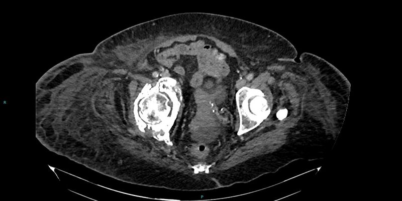 File:Breast cancer pelvic bony metastases (Radiopaedia 84470-99824 Axial bone window 53).jpg