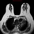 Breast carcinoma (multicentric multifocal in mammary Paget disease) (Radiopaedia 50966-56512 Axial T2 11).jpg
