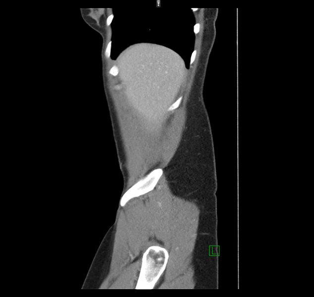File:Broad ligament hernia (Radiopaedia 63260-71832 C 6).jpg