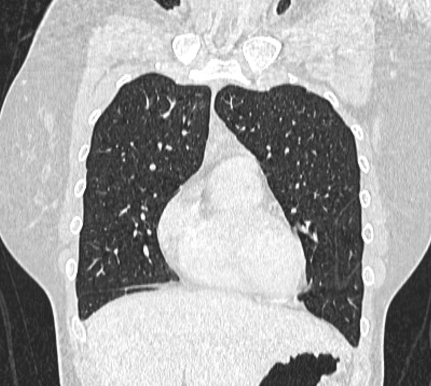 Bronchial atresia (Radiopaedia 50007-55297 Coronal lung window 23).jpg