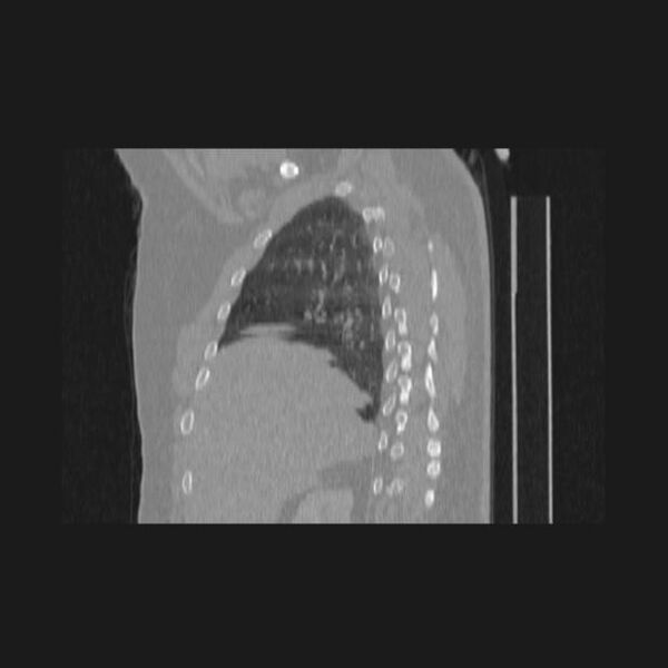 File:Bronchial atresia (Radiopaedia 60685-68439 Sagittal lung window 20).jpg